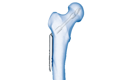 dhs-system-blade-locking-trochanter-stabilization-plate